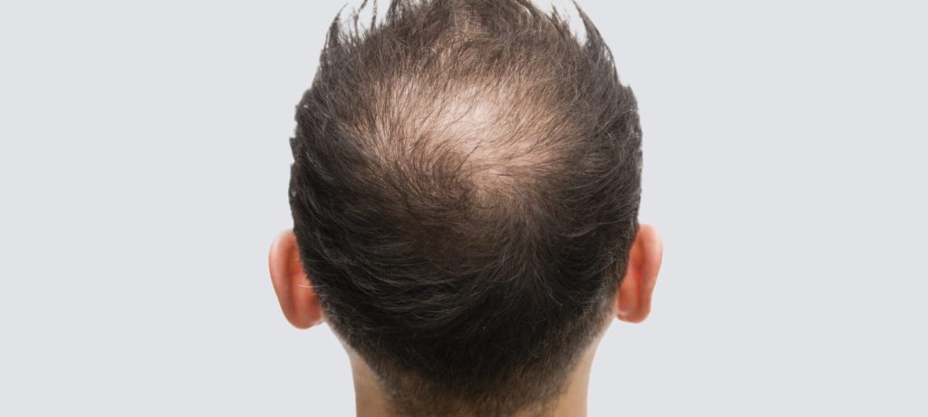 PRP Behandlung Haare Bremen