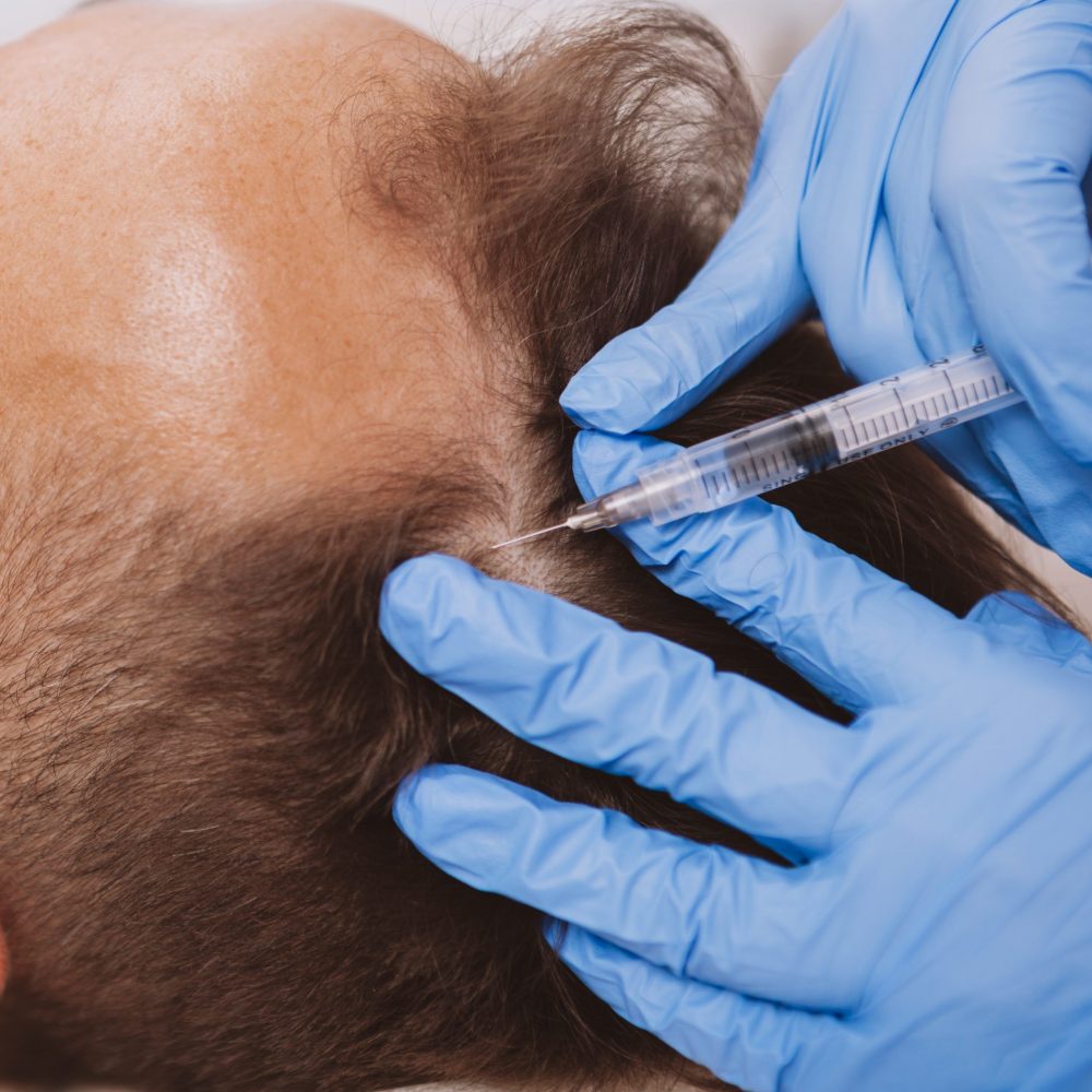 Haarausfall EIgenbluttherapie Eigenbluttherapie
