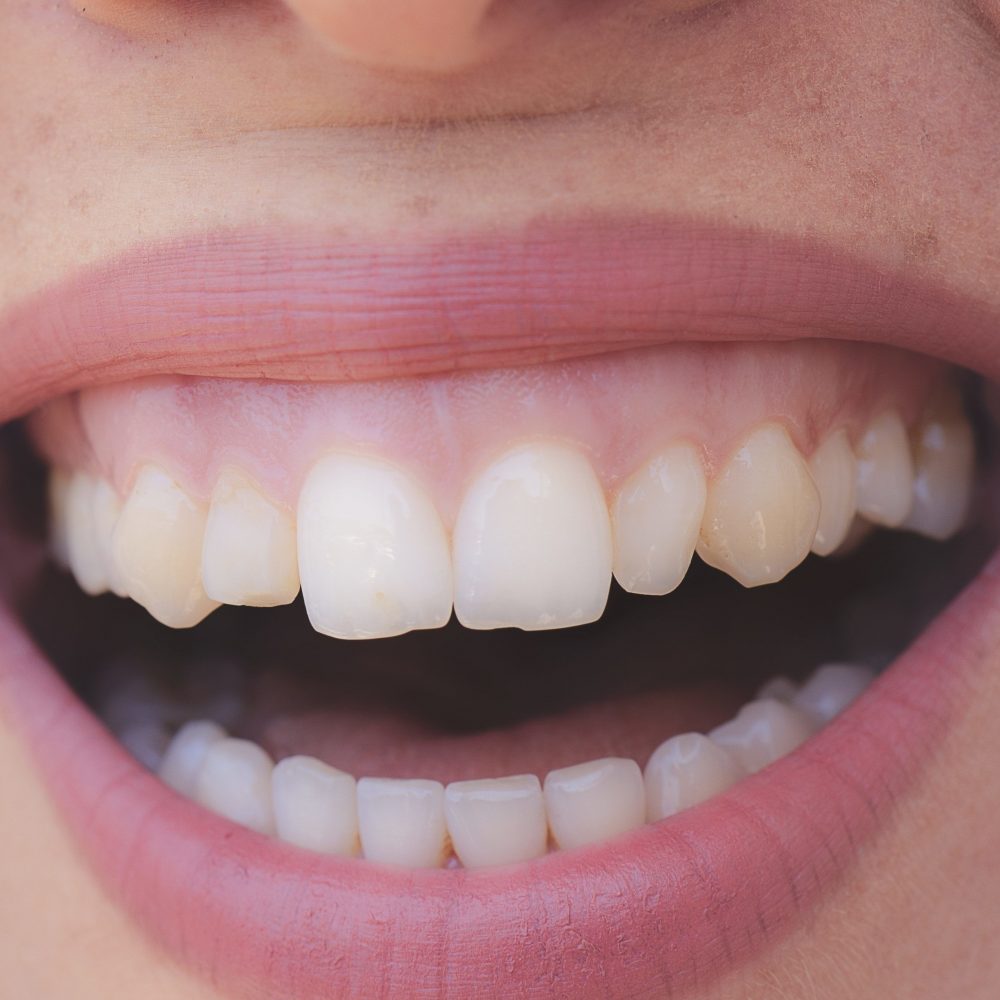 Zahnfleischlächeln Gummysmile Zahnfleischlächeln behandeln
